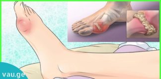 ყველაზე სწრაფი მკურნალობა ნიკრისის ქარის წინააღმდეგ. ეფექტური მეთოდია