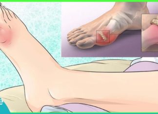 ყველაზე სწრაფი მკურნალობა ნიკრისის ქარის წინააღმდეგ. ეფექტური მეთოდია