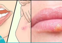 ჰერპესის ვირუსს ეს ბუნებრივი საშუალებები ყველაზე ეფექტურად ებრძვიან. მოიშორეთ უსიამოვნო გამონაყარი მარტივად