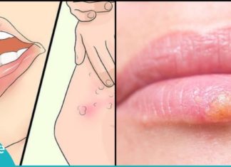 ჰერპესის ვირუსს ეს ბუნებრივი საშუალებები ყველაზე ეფექტურად ებრძვიან. მოიშორეთ უსიამოვნო გამონაყარი მარტივად
