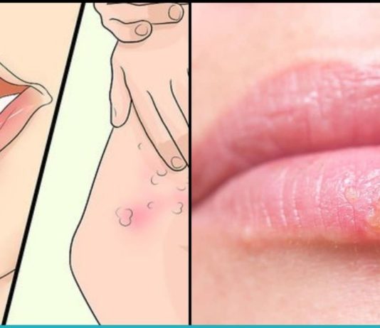ჰერპესის ვირუსს ეს ბუნებრივი საშუალებები ყველაზე ეფექტურად ებრძვიან. მოიშორეთ უსიამოვნო გამონაყარი მარტივად