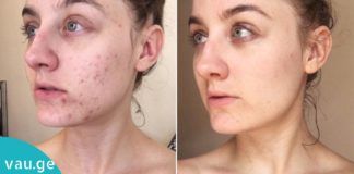 ინგრედიენტი, რომელიც აკნეს სამუდამოდ დაგავიწყებთ. ყველაზე ეფექტური საშუალებაა