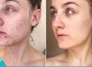 ინგრედიენტი, რომელიც აკნეს სამუდამოდ დაგავიწყებთ. ყველაზე ეფექტური საშუალებაა