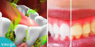 ინგრედიენტი, რომელიც პირის ღრუში ყველა ბაქტერიას ანადგურებს. საუკეთესო საშუალებაა