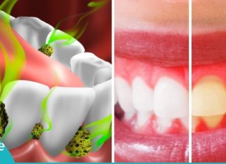 ინგრედიენტი, რომელიც პირის ღრუში ყველა ბაქტერიას ანადგურებს. საუკეთესო საშუალებაა