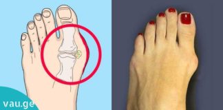 აი, როგორ უნდა მოიქცეთ ტერფის დეფორმაციის დროს. ეს რეცეპტი აუცილებლად გამოგადგებათ