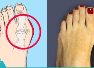 აი, როგორ უნდა მოიქცეთ ტერფის დეფორმაციის დროს. ეს რეცეპტი აუცილებლად გამოგადგებათ