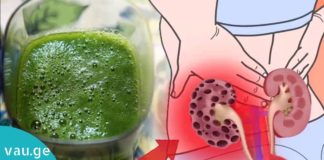 გსურთ თირკმელებიდან კენჭების მოშორება? ამაში ეს სიროფი დაგეხმარებათ