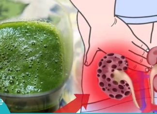 გსურთ თირკმელებიდან კენჭების მოშორება? ამაში ეს სიროფი დაგეხმარებათ