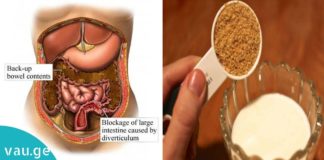 ნაწლავების გასუფთავების უმარტივესი მეთოდი… ნუ დახარჯავთ ზედმეტ ფულს!