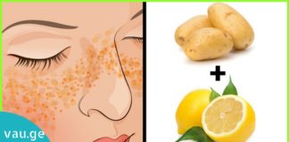 პიგმენტური ლაქების მოშორების სუპერმეთოდი! შედეგი გარანტირებულია