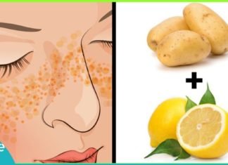 პიგმენტური ლაქების მოშორების სუპერმეთოდი! შედეგი გარანტირებულია