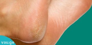 ეფექტური საშუალება, რომელიც გაუხეშებულ ქუსლებს ებრძვის. ძალიან მარტივია!