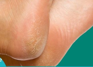 ეფექტური საშუალება, რომელიც გაუხეშებულ ქუსლებს ებრძვის. ძალიან მარტივია!