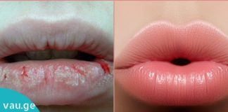 როგორ მოვუაროთ ტუჩებს და დავიცვათ გამოშრობისგან? ეს რჩევები აუცილებლად გამოგადგებათ