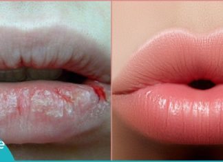 როგორ მოვუაროთ ტუჩებს და დავიცვათ გამოშრობისგან? ეს რჩევები აუცილებლად გამოგადგებათ