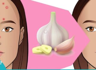 დაამარცხეთ გამონაყარი სახეზე ნიორის დახმარებით. ამაზე ეფექტური საშუალება არ არსებობს!