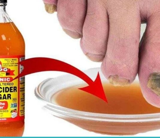 აი რისთვის იყენებს ის ვაშლის ძმარს. ასეთ შედეგს ნამდვილად არ ველოდი!