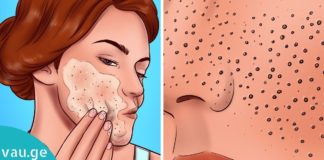 აურიეთ ეს ორი პროდუქტი და სამუდამოდ გაგიქრობთ შავ წერტილებს!