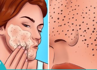 აურიეთ ეს ორი პროდუქტი და სამუდამოდ გაგიქრობთ შავ წერტილებს!