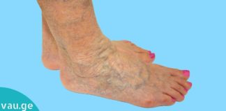 როგორ დავამარცხოთ ვარიკოზული ვენების პრობლება?! ამაში ეს ნატურალური საშულებები დაგეხმარებათ