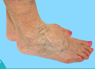 როგორ დავამარცხოთ ვარიკოზული ვენების პრობლება?! ამაში ეს ნატურალური საშულებები დაგეხმარებათ