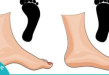 შეიძლება თუ არა ბრტყელტერფიანობამ სერიოზული დაავადებების გამოიწვიოს?! ამას არ მოველოდი