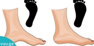 შეიძლება თუ არა ბრტყელტერფიანობამ სერიოზული დაავადებების გამოიწვიოს?! ამას არ მოველოდი