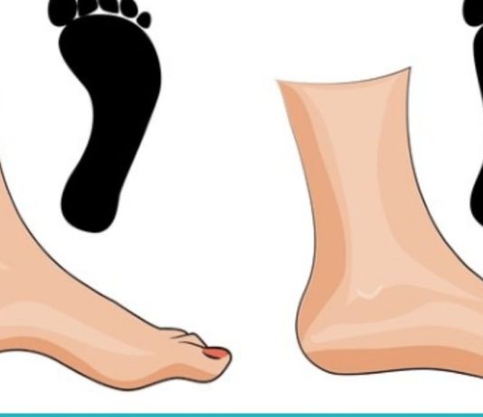 შეიძლება თუ არა ბრტყელტერფიანობამ სერიოზული დაავადებების გამოიწვიოს?! ამას არ მოველოდი