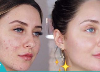 აი ასე უნდა მოვიშოროთ აკნესგან დატოვებული ნაიარევი ნატურალური პროდუქტების დახმარებით!