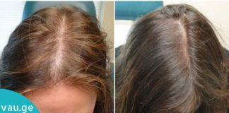 თმის გაზრდის ყველაზე სწრაფი გზა. მხოლოდ და მხოლოდ 2 ინგრედიენტი!