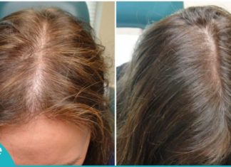 თმის გაზრდის ყველაზე სწრაფი გზა. მხოლოდ და მხოლოდ 2 ინგრედიენტი!