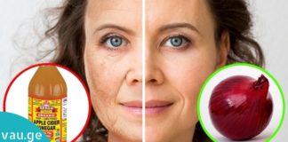 როგორ მოვიშოროთ ასაკისგან გამოწვეული პიგმენტური ლაქები სახლში დამზადებული საშუალებით?