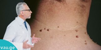 პაპილომების მოშორების ხალხური მეთოდები. ეს ინგრედიენტები ყველას სამზარელოში მოიძებნება