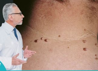 პაპილომების მოშორების ხალხური მეთოდები. ეს ინგრედიენტები ყველას სამზარელოში მოიძებნება