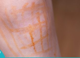 რა სამკურნალო თვისებები აქვს იოდის ბადეს? ეს ინფორმაცია გამოგადგებათ