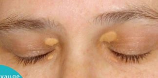 თვალების ირგვლივ ქსანტელაზმას მოშორების ბუნებრივი მეთოდები. დაივიწყეთ ეს პრობლემა სამუდამოდ