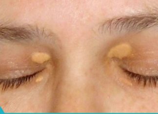 თვალების ირგვლივ ქსანტელაზმას მოშორების ბუნებრივი მეთოდები. დაივიწყეთ ეს პრობლემა სამუდამოდ
