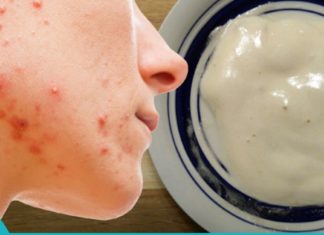 გამოიყენეთ ეს ნიღაბი 5 წუთის განმავლობაში ყოველდღიურად და დააკვირდით შედეგებს: შავი წერტილები, გამონაყარი და ნაოჭები სასწრაფოდ გაქრება!