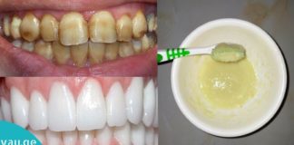 გაითეთრეთ კბილები სახლში სულ რაღაც 3-წუთში. 100%-ით ეფექტური მეთოდი!