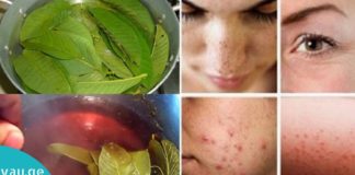 გამოიყენეთ გუავას ფოთლები, რომ მოიშოროთ ნაოჭები, აკნე, მუქი ლაქები და კანის ალერგიული რეაქციები!