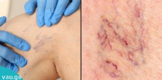 მოიშორეთ სისხლძარღვოვანი “ვარსკვლავები” ფეხებიდან წამლებისა და ოპერაციის გარეშე