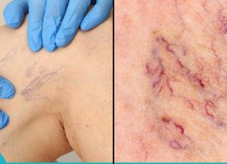 მოიშორეთ სისხლძარღვოვანი “ვარსკვლავები” ფეხებიდან წამლებისა და ოპერაციის გარეშე