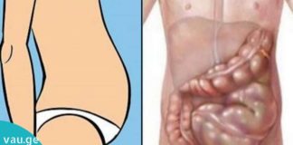 სწრაფად და ეფექტურად გათავისუფლდით გაზებისა და მუცლის შებერილობისგან ამ 7 საშუალებით!