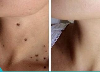 8 ყველაზე ეფექტური რეცეპტი პაპილომას სამკურნალოდ