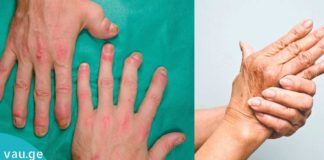 ვინ იფიქრებდა! კარტოფილი და კეფირი ართრიტის წინააღმდეგ!