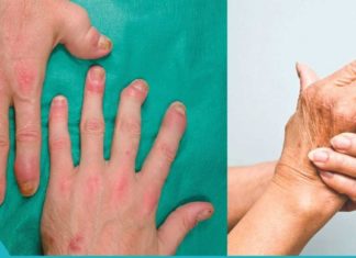 ვინ იფიქრებდა! კარტოფილი და კეფირი ართრიტის წინააღმდეგ!