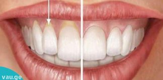 ღრძილების რეცესია -11 სახლის პროდუქტი მის სამკურნალოდ!