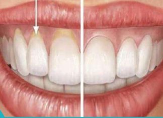 ღრძილების რეცესია -11 სახლის პროდუქტი მის სამკურნალოდ!