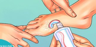 მოამზადეთ კრემი კბილის პასტისგან და წაისვით დაწოლის წინ. როდესაც გაიღვიძებთ, შედეგით გაოცდებით